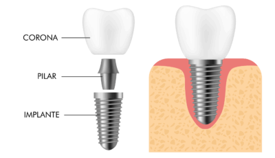 11Partes de un implante dental. Corona, Pilar, Implante