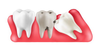 11Ilustración odontológica de tres muelas en la encía